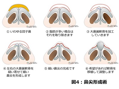 神戸大学医学部附属病院 美容外科 鼻中隔延長術 より